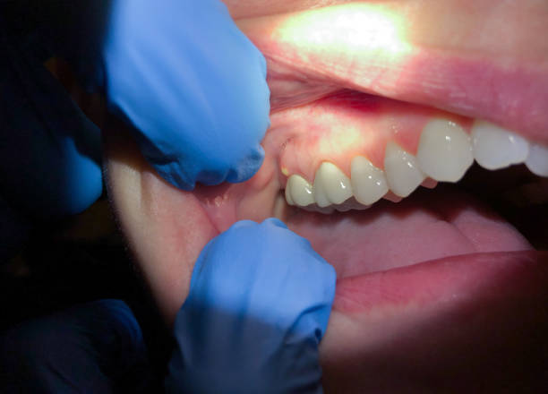 Best Emergency Broken Tooth Repair in Carthage, NC